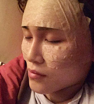 长沙雅美自体脂肪填充全脸案例分享