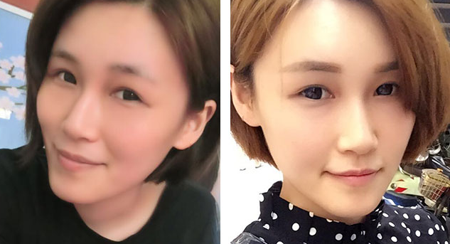 长沙雅美自体脂肪填充全脸案例分享