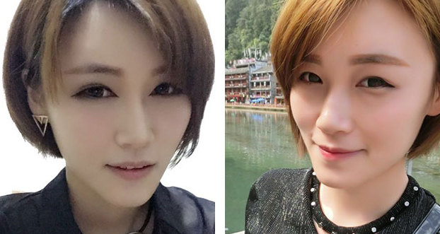 长沙雅美自体脂肪填充全脸案例分享