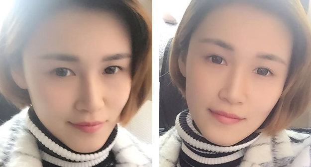 长沙雅美自体脂肪填充全脸案例分享