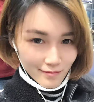 长沙雅美自体脂肪填充全脸案例分享