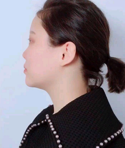 *和单纯隆鼻有什么区别?