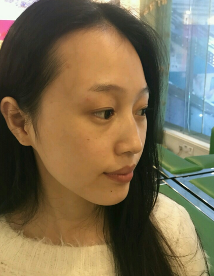 用什么材料做隆鼻好?北京韩啸假体隆鼻好不好?