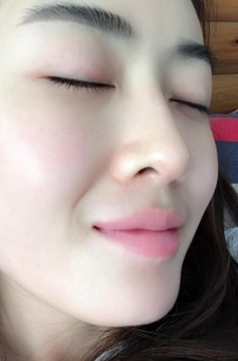成都天使之翼整形医院隆鼻怎么样?做*多