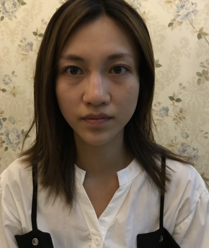 假体隆鼻、注射隆鼻、*:哪个好?