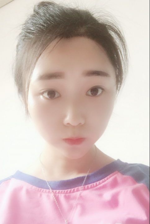 广州植发快5个月了,头发慢慢长多了
