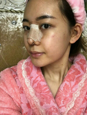 武汉硅胶隆鼻，恢复300天了，挺美的