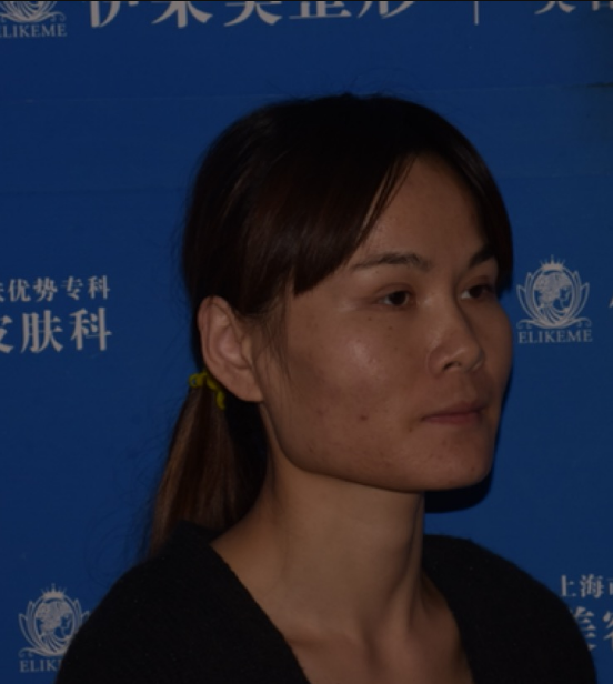 上海磨骨第75天了，已经消肿，*果不错
