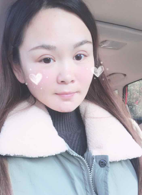 上海磨骨第75天了，已经消肿，*果不错