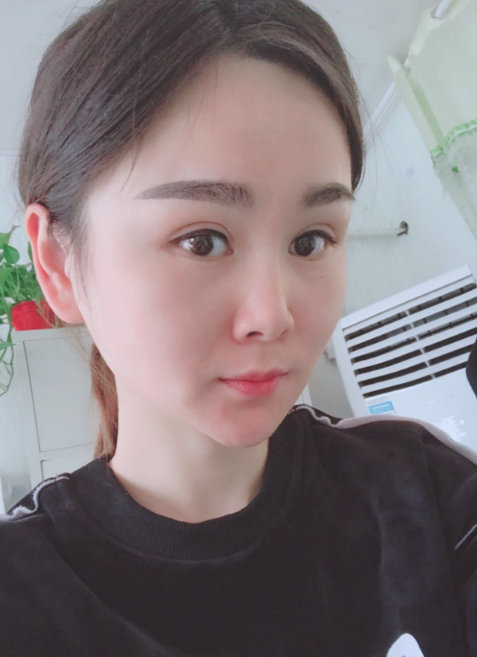 上海磨骨第75天了，已经消肿，*果不错