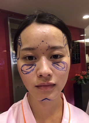 重庆自体脂肪填充面部第72天了，*果很好