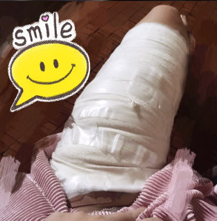 重庆自体脂肪填充面部第72天了，*果很好