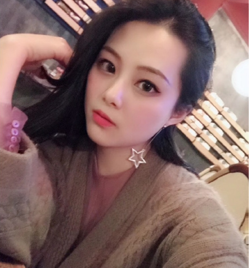 重庆自体脂肪填充面部第72天了，*果很好