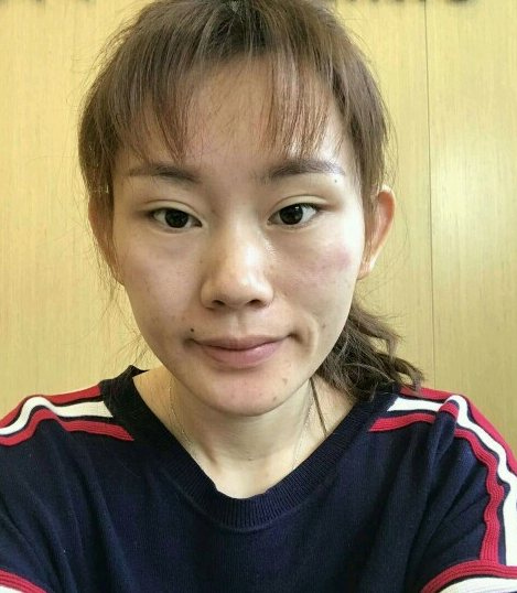 北京叶美人自体脂肪填充面部的*果怎么样？案