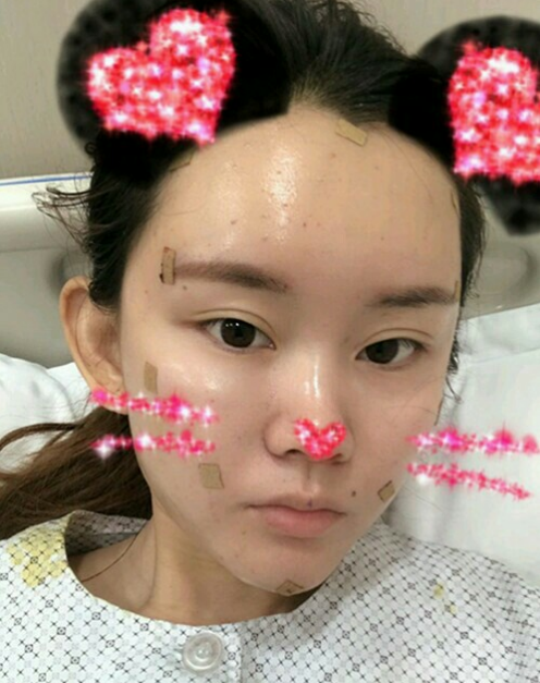 北京叶美人自体脂肪填充面部的*果怎么样？案