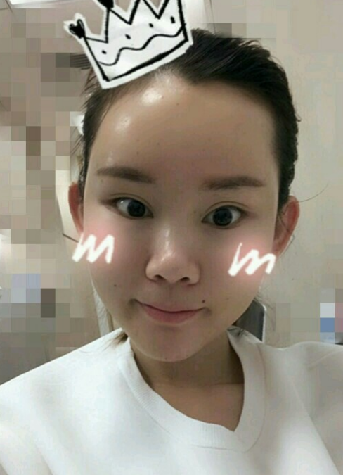 北京叶美人自体脂肪填充面部的*果怎么样？案
