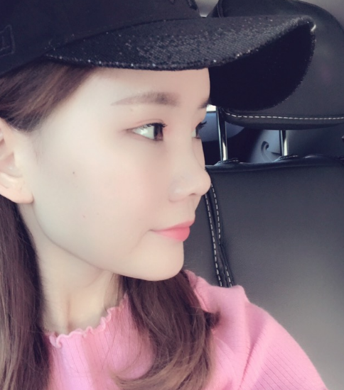 北京叶美人自体脂肪填充面部的*果怎么样？案