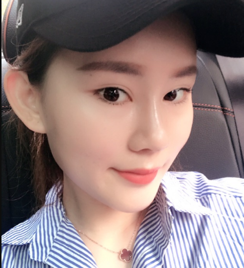北京叶美人自体脂肪填充面部的*果怎么样？案