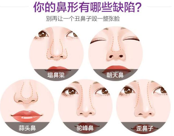 做隆鼻手术先别急！先看完这些隆鼻知识