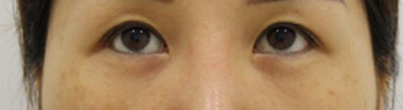 双眼皮修复后拆线，给大家看看第六天就拆线的