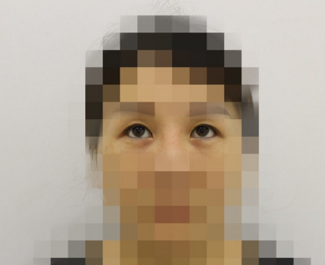 双眼皮修复后拆线，给大家看看第六天就拆线的