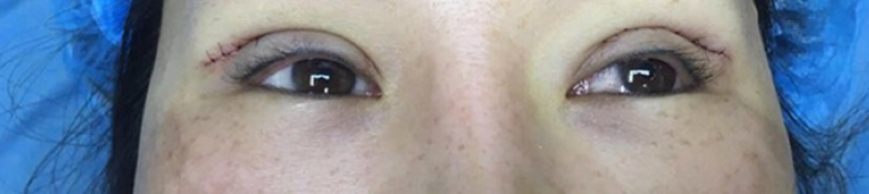 双眼皮修复后拆线，给大家看看第六天就拆线的