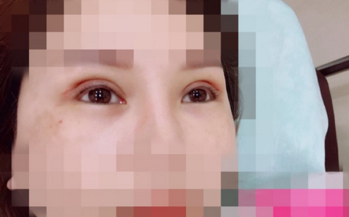 双眼皮修复后拆线，给大家看看第六天就拆线的