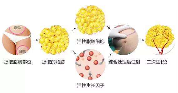为什么有人做完自体脂肪填充后会很别扭不自然