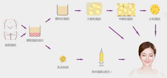 关于自体脂肪填充的6大疑问以及*果