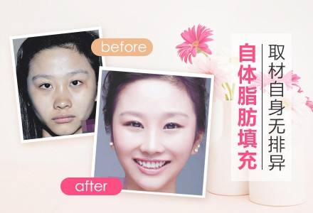 关于自体脂肪填充,大家在意的六大问题