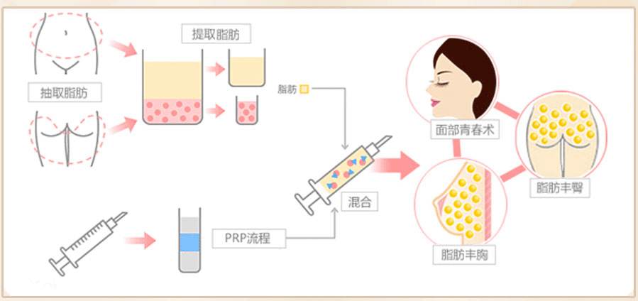 自体脂肪移植的适应症以及能的*果
