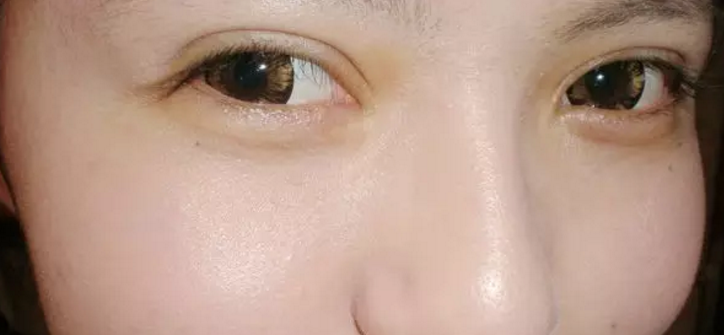 为什么有些人的双眼皮一眼就被人看出是做的?