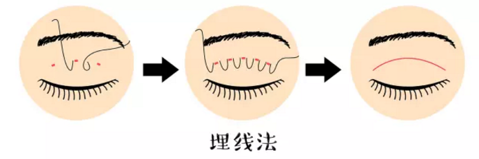 双眼皮的形状,宽度,术式选择