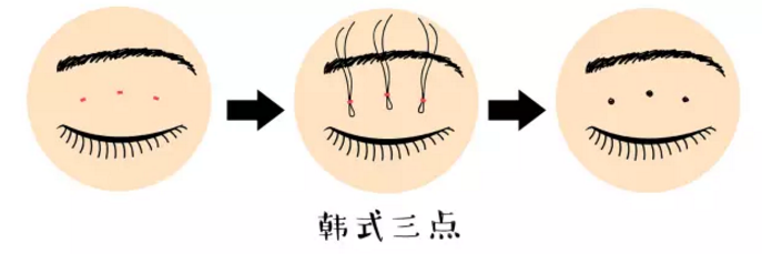 双眼皮的形状,宽度,术式选择