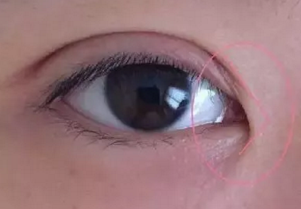 我只想割双眼皮,医院为什么建议开眼角?