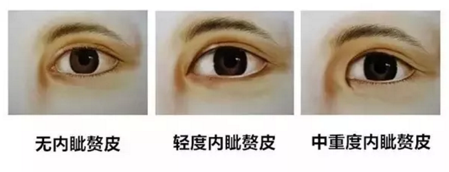 我只想割双眼皮,医院为什么建议开眼角?