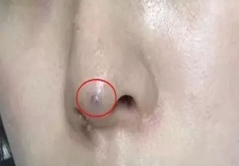 为什么隆鼻医生都不建议做*?