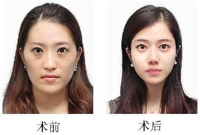 上海磨骨瘦脸手术多少钱?