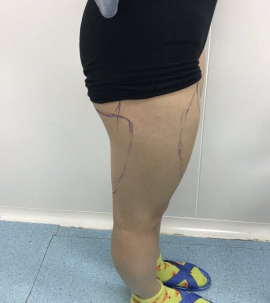 八大处东院齐越医生大腿环吸+臀下线+脂肪填屁股