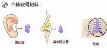 自体软骨隆鼻和异体软骨隆鼻的比较