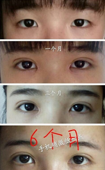 丽水美莱整形医院全切双眼皮、内眼角价格6800