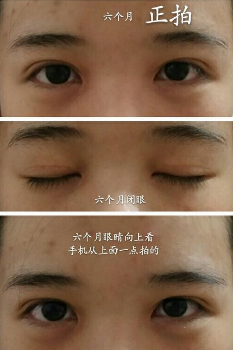 丽水美莱整形医院全切双眼皮、内眼角价格6800