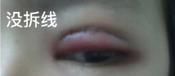 长沙雅美赵茜医生全切双眼皮、割麦粒肿