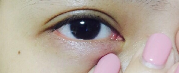 长沙雅美赵茜医生全切双眼皮、割麦粒肿