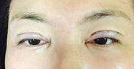 深圳美莱陈磊医生全切➕开眼角价格6800元