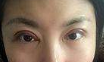 深圳美莱陈磊医生全切➕开眼角价格6800元