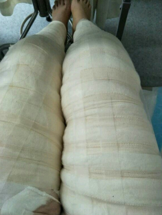 大腿环吸,坐标,深圳,瘦腿*果很棒,附深圳