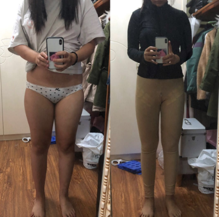 福州吸脂瘦大腿四个月的*果,瘦了,福州公立