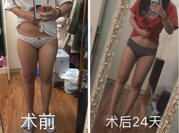 福州吸脂瘦大腿四个月的*果,瘦了,福州公立