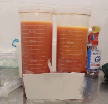 济南吸脂瘦腰腹105天的*果以及济南吸脂好的医